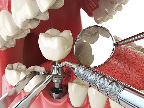 Best Emergency Tooth Extraction in Muscatine, IA